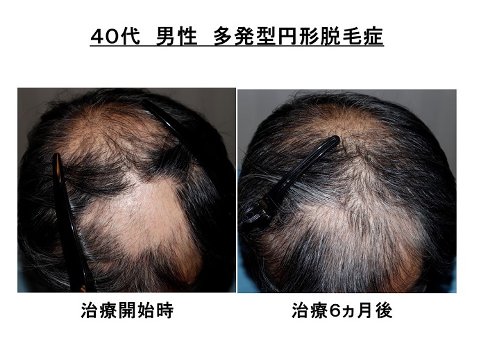 円形脱毛症　病院